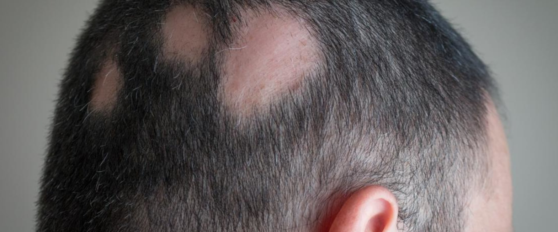 Understanding Alopecia: Causes, Treatment, and Pain Management