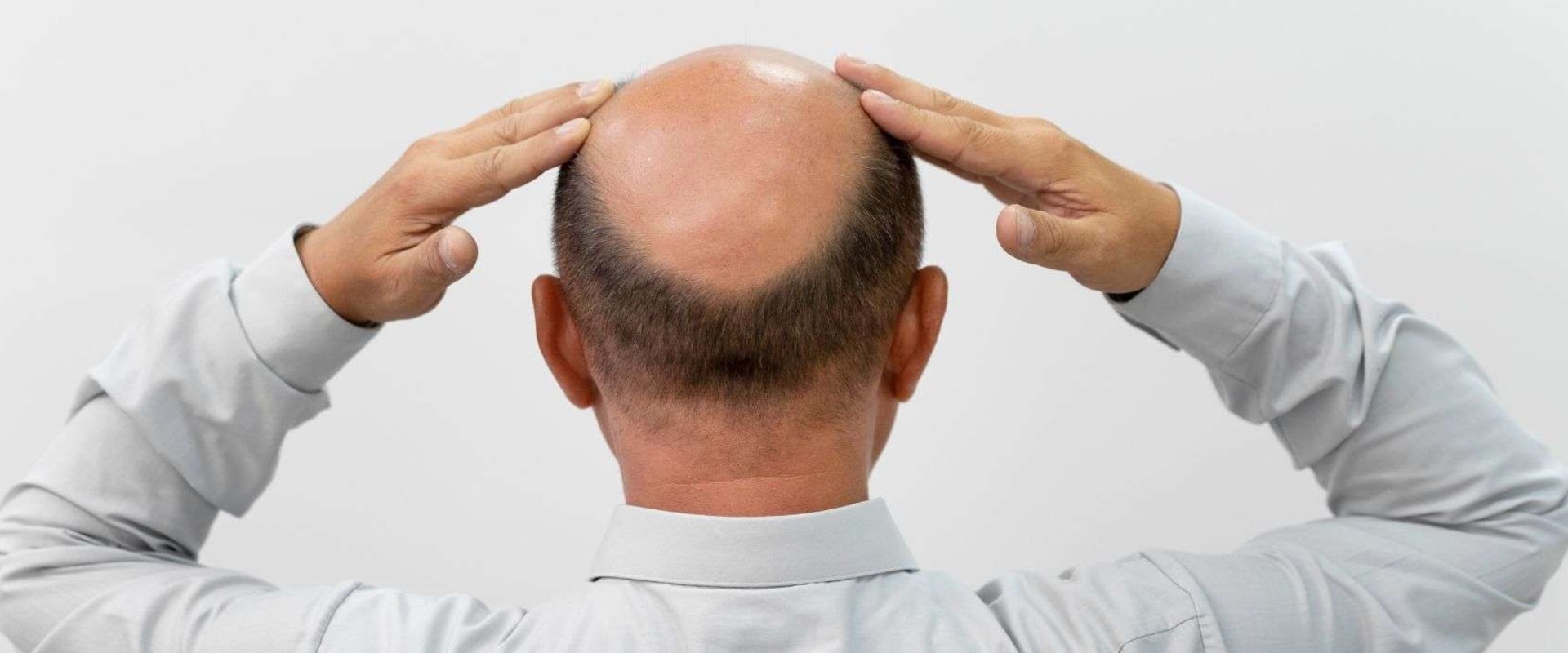 Understanding the Link Between Lifestyle Factors and Male Pattern Baldness