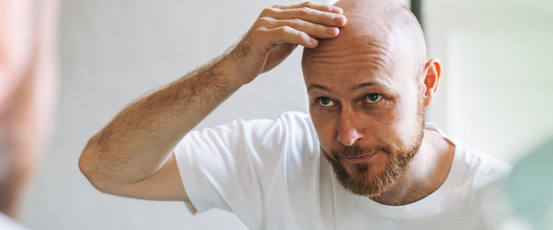 Understanding Medical Treatments for Male Pattern Baldness