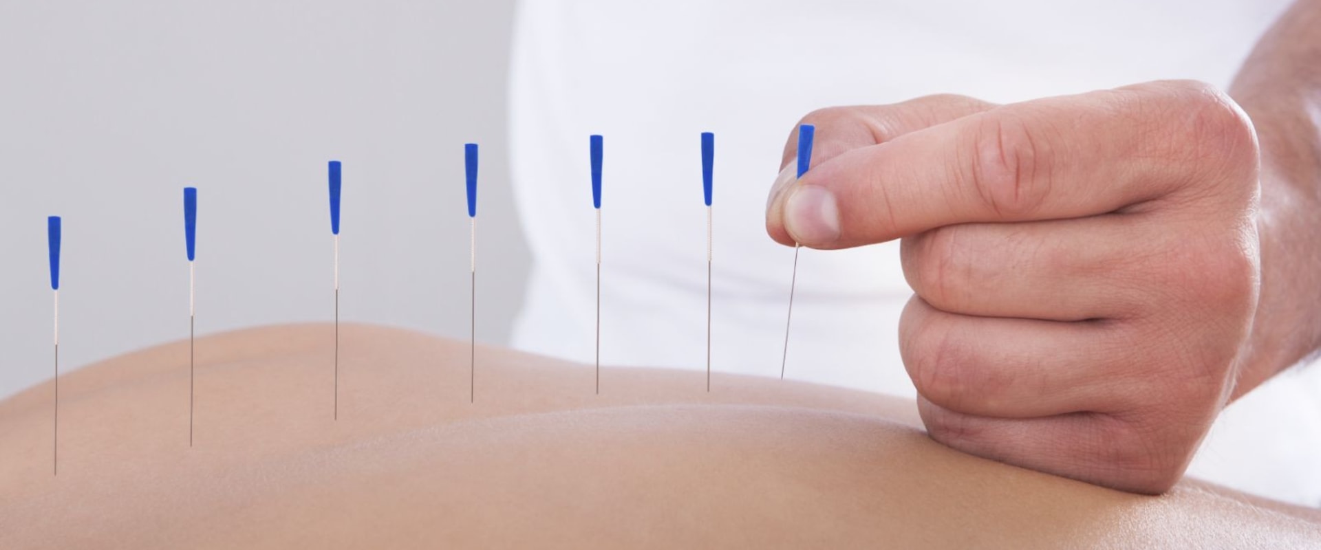 How Acupuncturists Can Help You Manage Chronic Pain