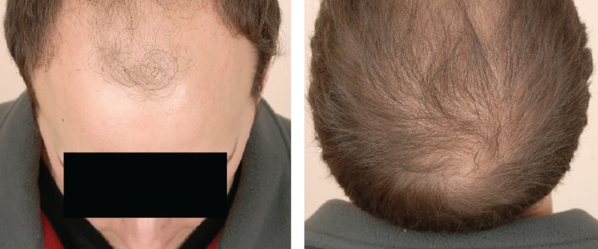 Understanding Male Pattern Baldness: Causes, Symptoms, and Treatment Options