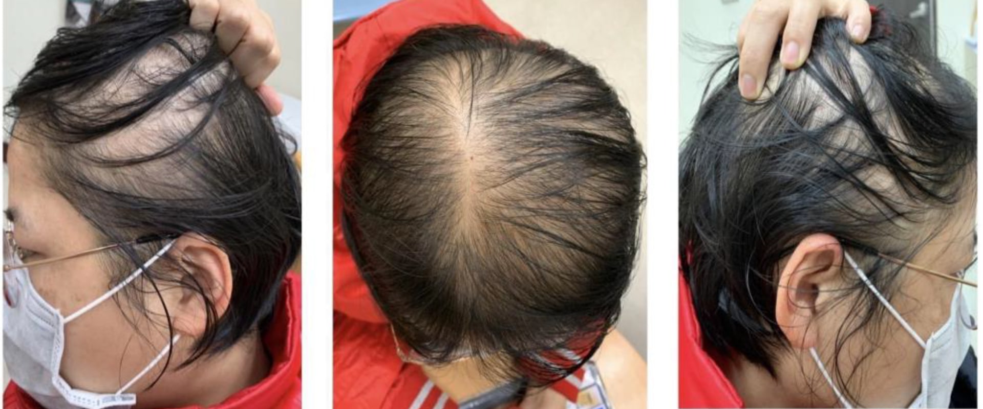 Understanding Hereditary Hair Loss