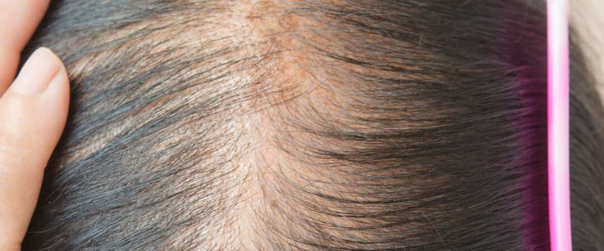 Iron-deficiency Anemia and Hair Loss: Understanding the Connection