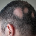 Understanding Alopecia: Causes, Treatment, and Pain Management