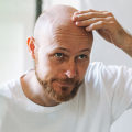 Understanding Medical Treatments for Male Pattern Baldness