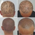 Scalp Camouflage Techniques: How to Manage Chronic Pain in Hair Loss