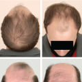 Understanding Male Pattern Baldness: Causes, Symptoms, and Treatment Options