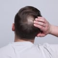 Understanding Finasteride: A Comprehensive Guide to Managing Chronic Pain