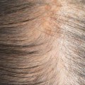 Iron-deficiency Anemia and Hair Loss: Understanding the Connection