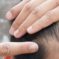 Understanding Hormonal Changes and Male Pattern Baldness