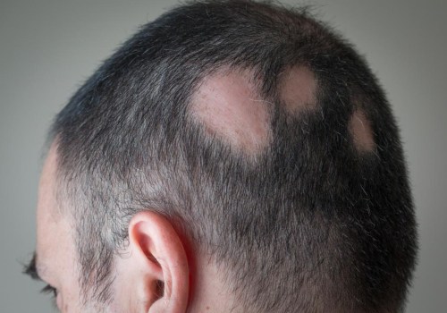 Understanding Alopecia: Causes, Treatment, and Pain Management