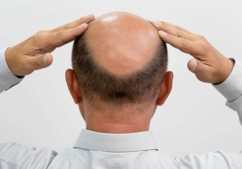 Understanding the Link Between Lifestyle Factors and Male Pattern Baldness