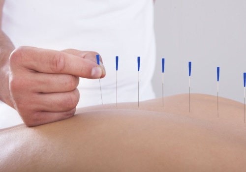 How Acupuncturists Can Help You Manage Chronic Pain