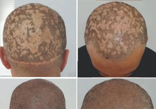 Scalp Camouflage Techniques: How to Manage Chronic Pain in Hair Loss