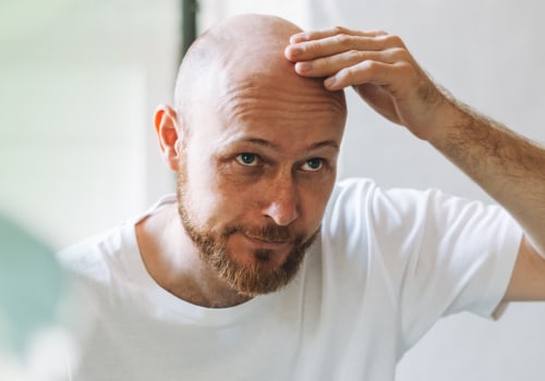 Understanding Genetics and Male Pattern Baldness