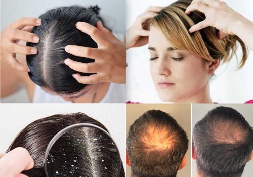 Scalp Massage for Hair Growth: How to Manage Chronic Pain and Promote Hair Regrowth