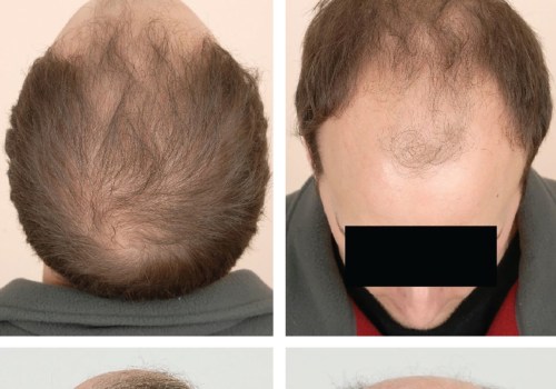 Understanding Male Pattern Baldness: Causes, Symptoms, and Treatment Options