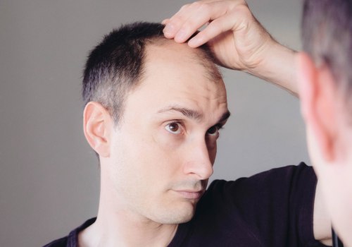 Lifestyle Changes to Prevent Male Pattern Baldness