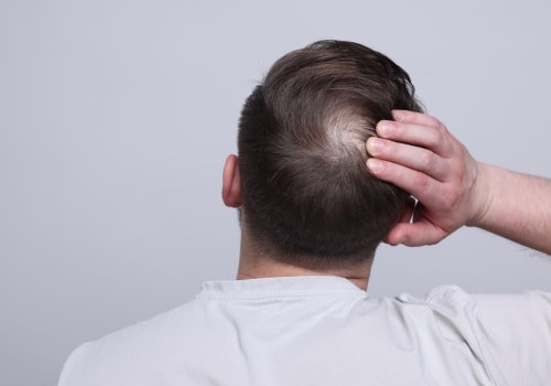 Understanding Finasteride: A Comprehensive Guide to Managing Chronic Pain