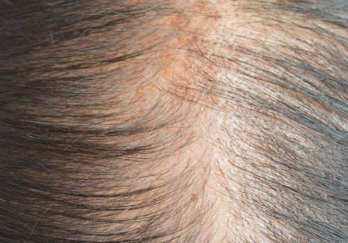 Iron-deficiency Anemia and Hair Loss: Understanding the Connection