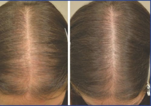 Understanding Medical Treatments for Female Hair Loss